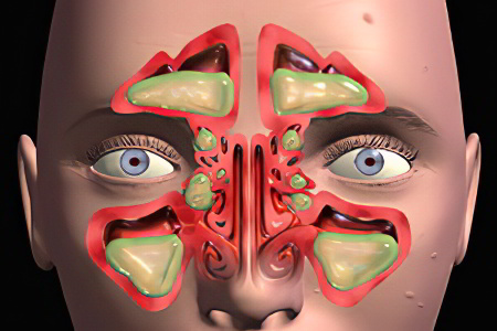 Осложнения фронтита Осложнения фронтита