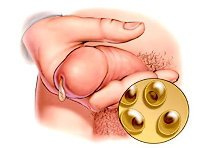 Осложнения гонореи Осложнения гонореи