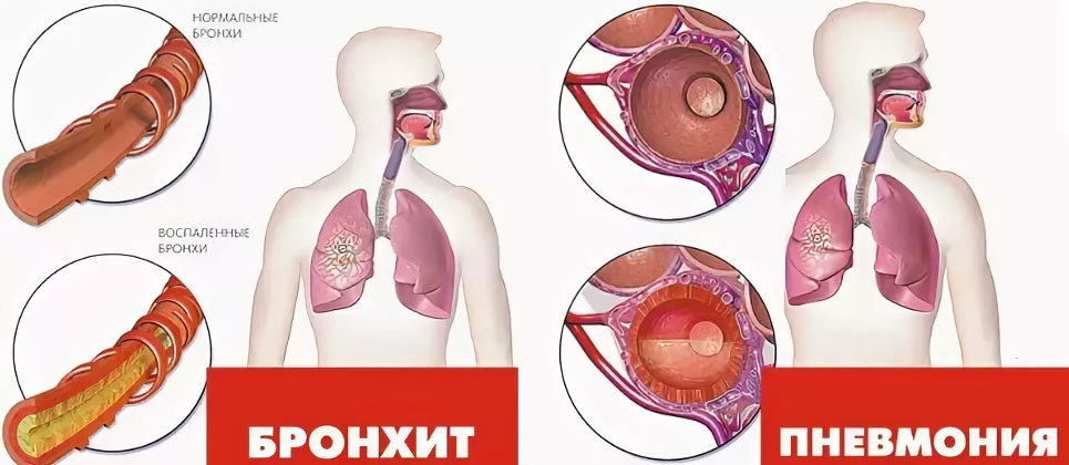 Отличия пневмонии от бронхита Отличия пневмонии от бронхита