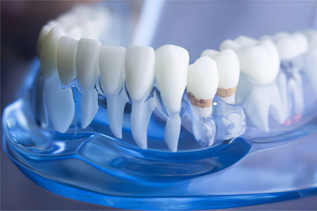 Откуда берётся пародонтит Откуда берётся пародонтит