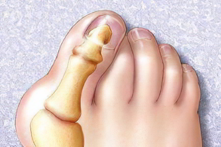 Перелом пальца на ноге Перелом пальца на ноге