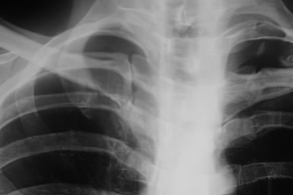 перелом первого ребра перелом первого ребра