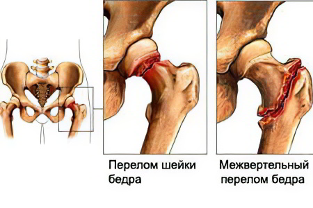 Переломы Переломы