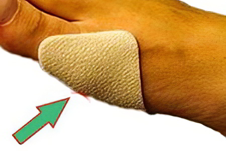 Перкутанная малоинвазивная остеотомия Перкутанная малоинвазивная остеотомия