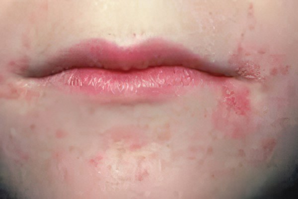 Пероральный дерматит Пероральный дерматит