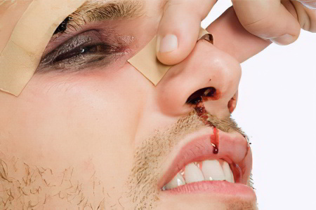 Первая помощь при переломе носа Первая помощь при переломе носа