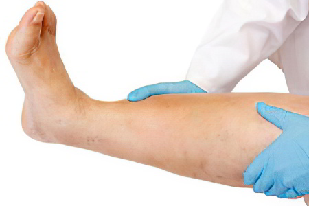 Первые симптомы амилоидоза почек Первые симптомы амилоидоза почек