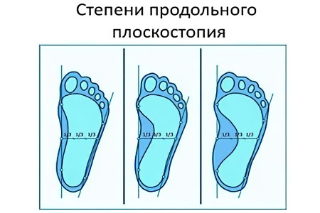 Продольное плоскостопие Продольное плоскостопие