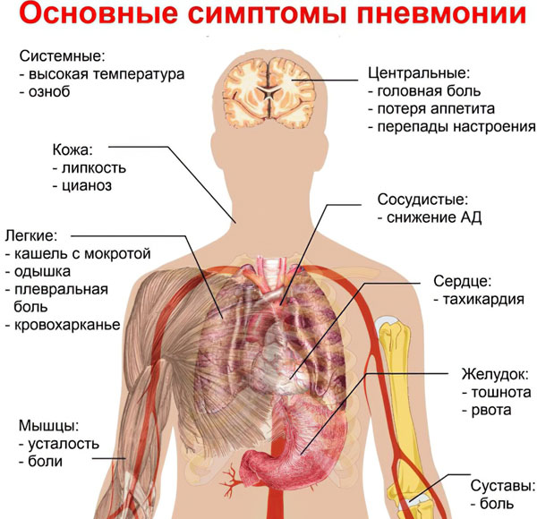 первые признаки начинающейся пневмонии первые признаки начинающейся пневмонии