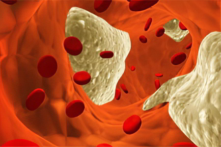 Почему может повышаться АСЛ-О Почему может повышаться АСЛ-О