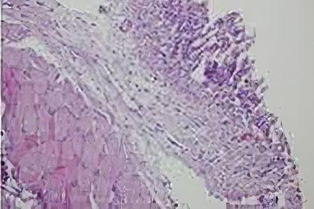 Подкожная эмфизема Подкожная эмфизема