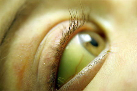 Пожелтение глазной склеры Пожелтение глазной склеры