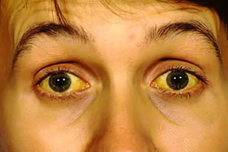 Пожелтение глазных склер Пожелтение глазных склер