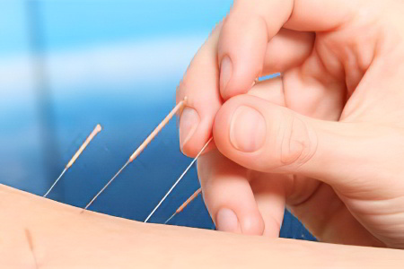 Помогает ли акупунктура при ВСД Помогает ли акупунктура при ВСД