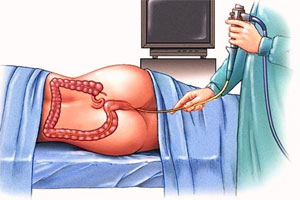 Порядок проведения колоноскопии Порядок проведения колоноскопии