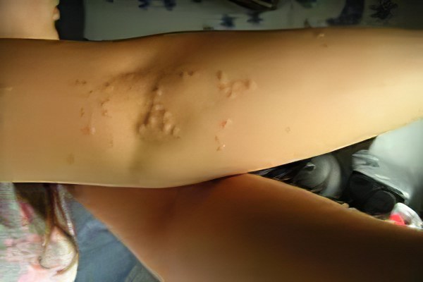 Последствия укусов постельных клопов Последствия укусов постельных клопов