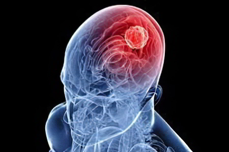 Причины отёка головного мозга Причины отёка головного мозга