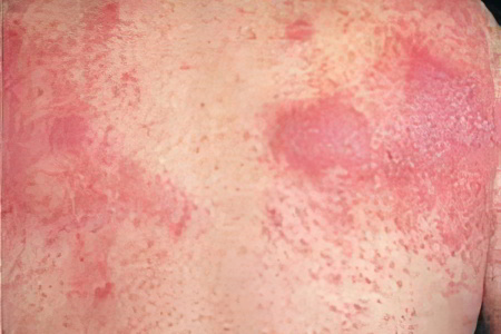 Причины атопического дерматита Причины атопического дерматита