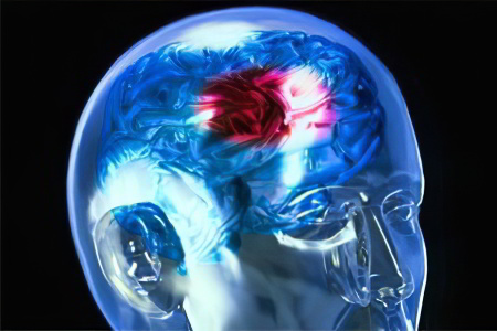 Причины инфаркта головного мозга Причины инфаркта головного мозга