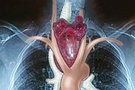 Причины многоузлового зоба Причины многоузлового зоба