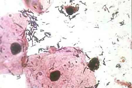 Причины молочницы у мужчи Причины молочницы у мужчи