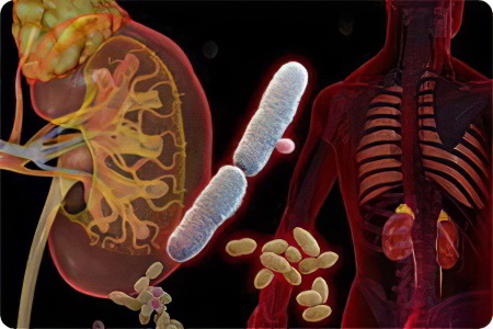 Причины острого пиелонефрита Причины острого пиелонефрита