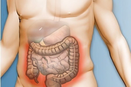 Причины рака прямой кишки Причины рака прямой кишки