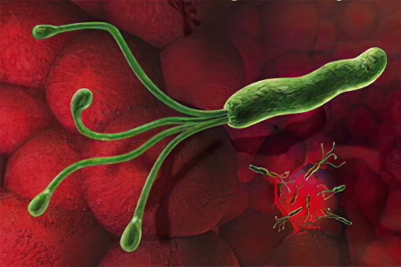 Причины язвы желудка Причины язвы желудка