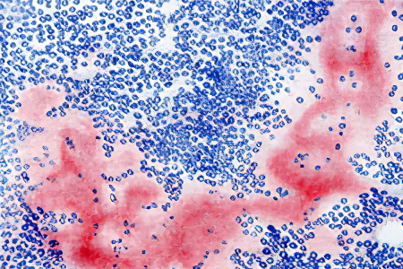 Причины амилоидоза Причины амилоидоза