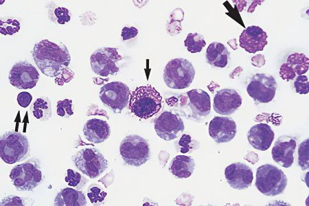 Причины гемосидероза Причины гемосидероза
