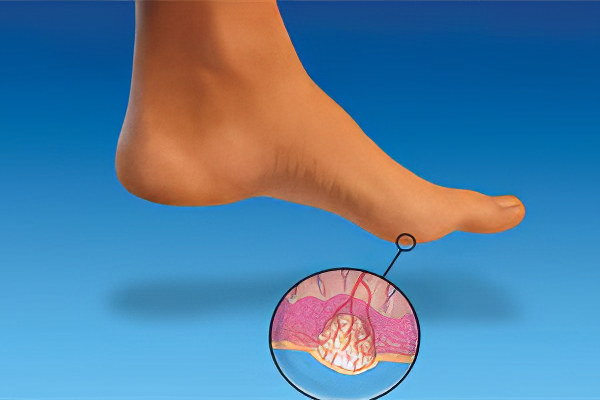 Причины подошвенных бородавок Причины подошвенных бородавок