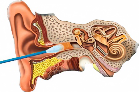 Причины появления серной пробки Причины появления серной пробки