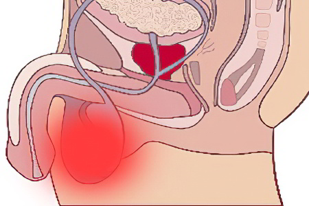 Причины возникновения боли в яичках у мужчин Причины возникновения боли в яичках у мужчин