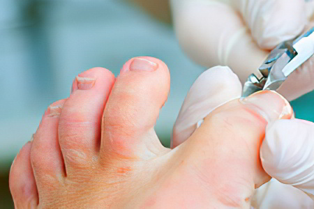 Причины врастания ногтя Причины врастания ногтя