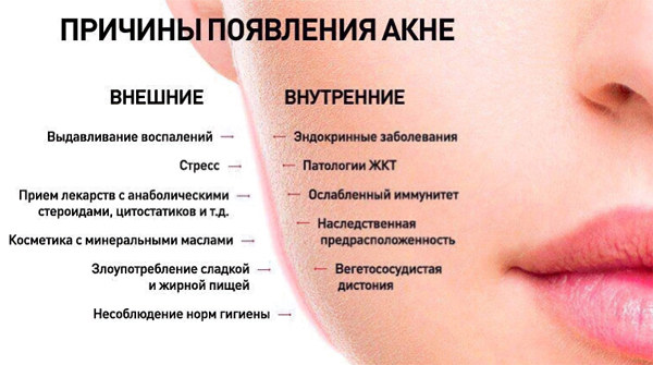 Причины появления акне Причины появления акне