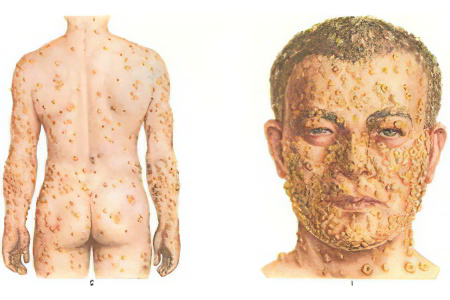 Проказа Проказа