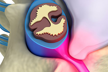 Протрузия межпозвоночного диска Протрузия межпозвоночного диска