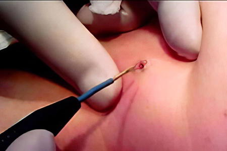 Метод радиоволновой хирургии Метод радиоволновой хирургии