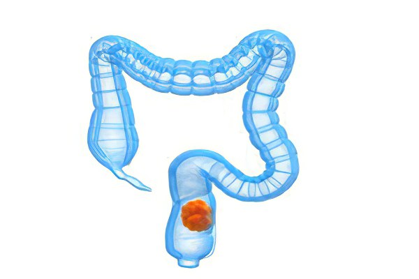 рак прямой кишки рак прямой кишки