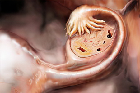 рак яичников рак яичников