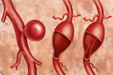 Разновидности аневризмы аорты Разновидности аневризмы аорты