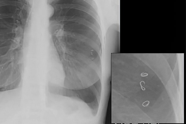 Рентгенография при аскаридозе Рентгенография при аскаридозе