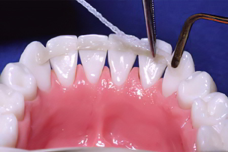 Шинирование зуба Шинирование зуба