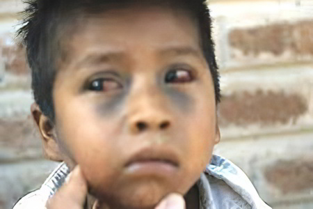 Симптомы подкожной эмфиземы Симптомы подкожной эмфиземы