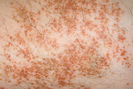 Симптомы гемосидероза Симптомы гемосидероза