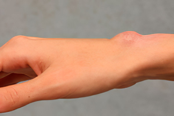 Симптомы гигромы Симптомы гигромы