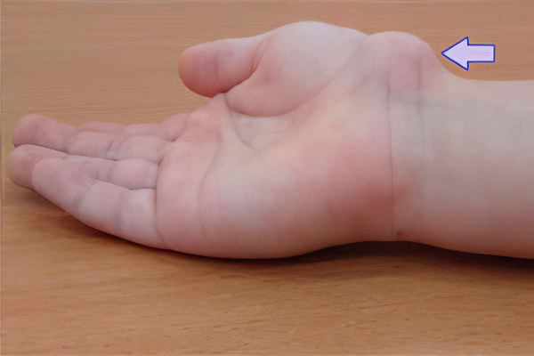 Симптомы гигромы запястья Симптомы гигромы запястья