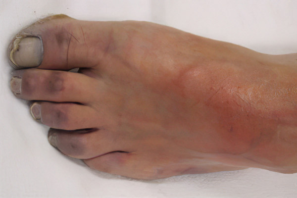 Симптомы влажной гангрены Симптомы влажной гангрены