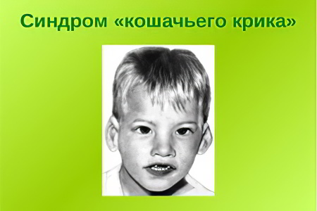 Симптомы синдрома кошачьего крика Симптомы синдрома кошачьего крика
