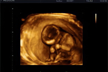 Скрининг на 13 неделе Скрининг на 13 неделе